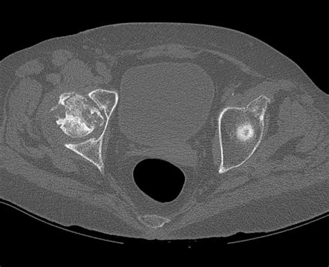 Avascular Necrosis Avn With Subchondral Collapse Right Femoral Head