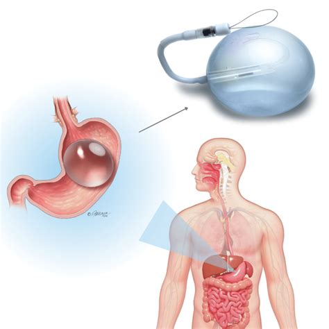 Balão Intragástrico Cronos Endoscopia