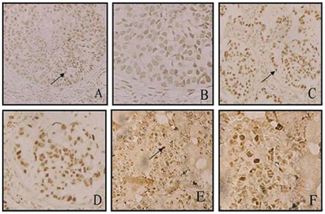 Lsd1 Expression And Distribution In Nsclc Tumor Tissues And Normal Lung