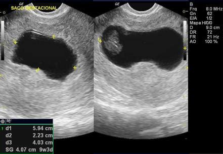 una vez Involucrado Panda gestational sac size calculator Personas con ...