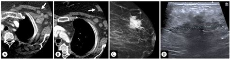 Axial CT images show an incidental finding of multiple left axillary ...