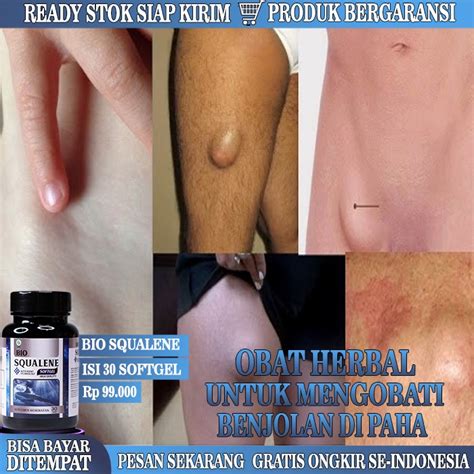 Jual Obat Benjolan Di Pangkal Paha Obat Benjolan Pada Paha Tak Kunjung