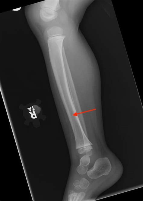 Unique Traumatic Fracture Patterns In Kids Uams Department Of Radiology