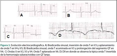 Alteraciones Electrocardiogr Ficas En Hemorragia Subaracnoidea