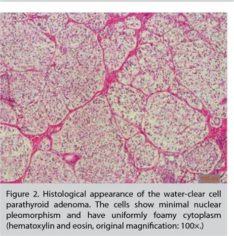 Figure From An Unusual Cause Of Hypercalcemic Crisis Water Clear