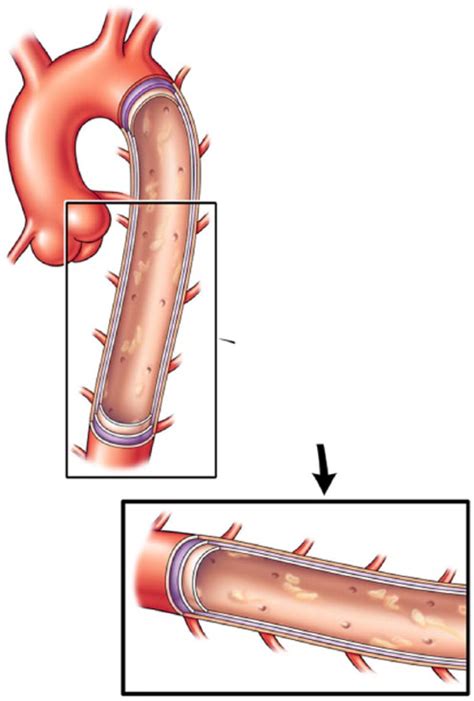 Aortic Dissection