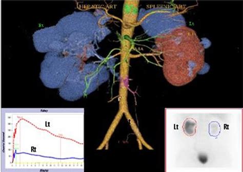 Figure 2 From Unusual Cause Of Bilateral Lower Limb Edema In A Male