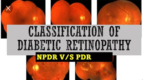 STAGES Of DIABETIC RETINOPATHY Mild Moderate Severe NPDR Vs PDR