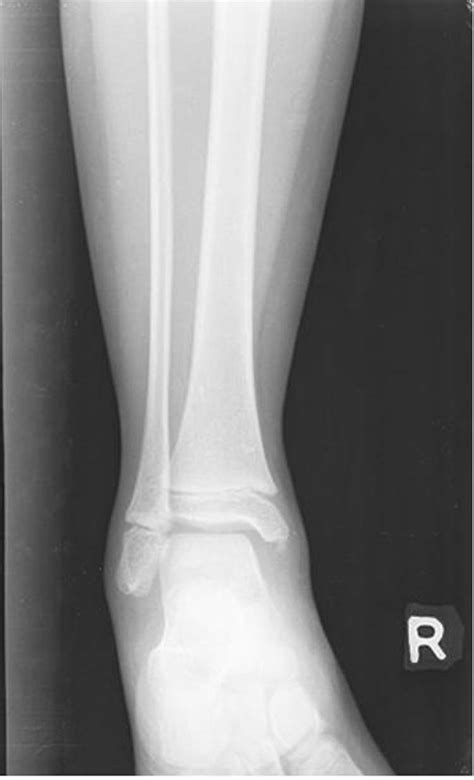 Accessory Os Subtibiale: A case report of misdiagnosed fracture | The ...