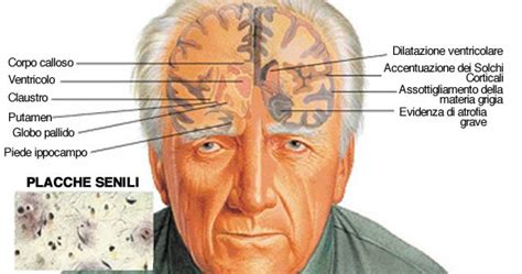 Ecco Come Sconfiggere La Demenza Prima Che Diventi Tardi