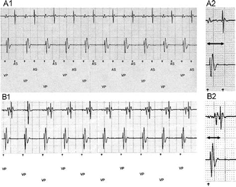 A 1 Pacemaker Telemetry Data During Endless Loop Tachycardia B 1 Download Scientific