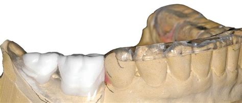 Dental Implant Surgical Guides Wiand Dental Lab