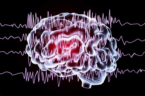 Simple Partial Seizures | Complex Partial Seizure