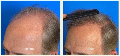 3000 Graft Hair Transplant On Norwood 6 Hair Loss Patient Video Hair