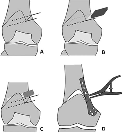 Different Stages Of The Medial Open Wedge Distal Femoral Osteotomy