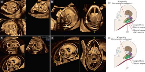 Non‐visualization Of Choroid Plexus Of Fourth Ventricle In First‐trimester As Abnormal Clue To