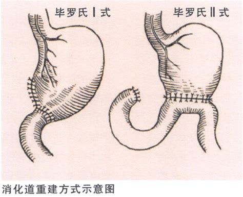 胃癌的手术治疗 肿瘤资讯 易加医