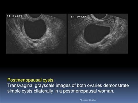 Sonographic Evaluation Of Pelvic Masses