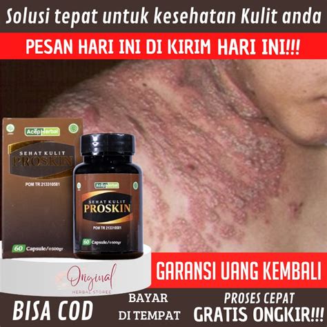 Jual Obat Eksim kering dan basah, Salep eksim basah, Obat eksim, Obat ...