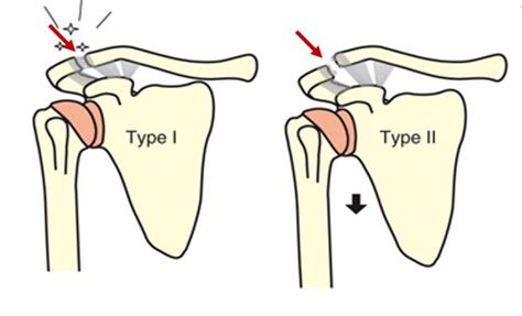 Dislocated Collarbone St Antonius Ziekenhuis