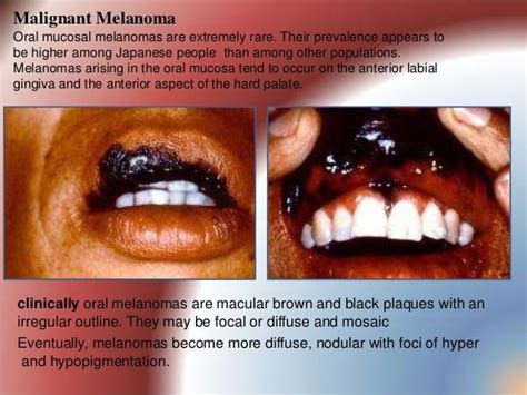 Pigmented lesions of oral mucosa