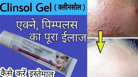 Clinsol Gel Uses In Hindi Clindamycin Phosphate Uses In Hindi Rs