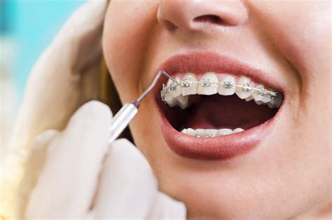 Perfect Smiles 7 Simple Advantages Of Metal Braces