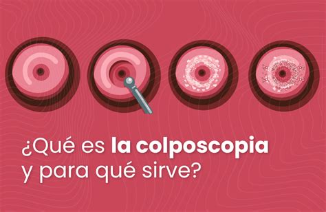 Qu Es La Colposcopia Y Para Qu Sirve Marie Stopes M Xico