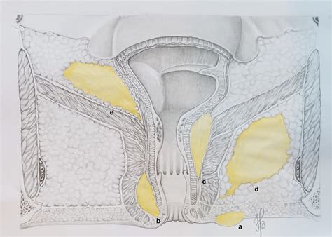 The Anatomical Definitions Of Anal Abscesses A Perianal B Low