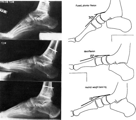 Plantar Flexion And Dorsiflexion