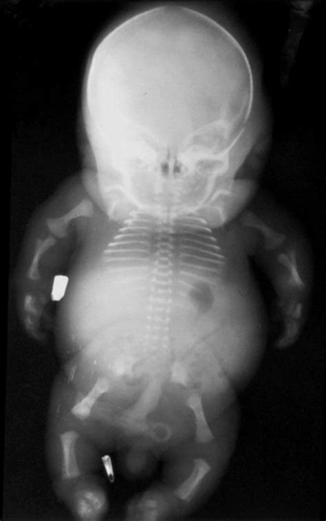 Achondroplasia Baby Buyxraysonline
