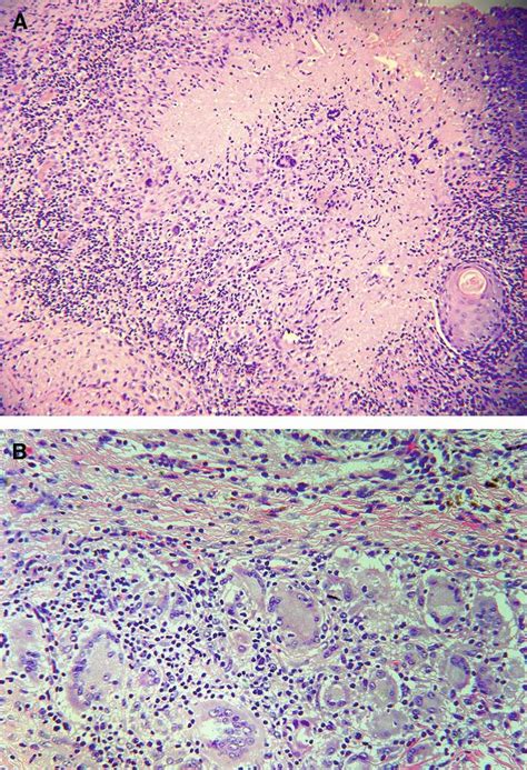 Histologic Analysis Of A Shoulder Lesion Biopsy Specimen From The