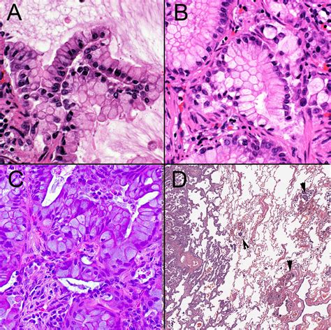 Updates In Grading And Invasion Assessment In Lung Adenocarcinoma