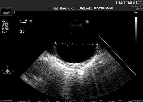 Transesophageal Echocardiogram Ascending Aortic Dilatation Download Scientific Diagram