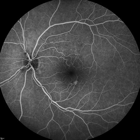 Angiografía fluoresceínica Institut de la Màcula