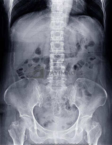 X Ray Abdomen Showing Anatomical In Abdomen For Diagnotic Abdominal