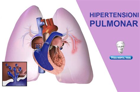 Si të njohim simptomat shkaqet që çojnë në Hipertension Pulmonar