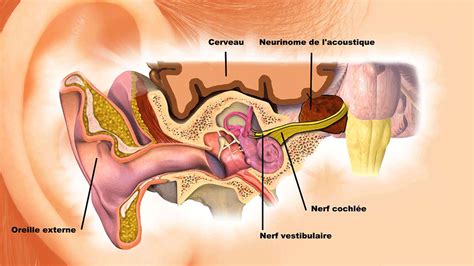 Le Neurinome Du Viii Vestibulaire Ch