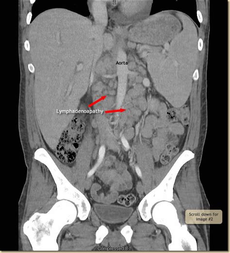 Abdominal Lympadenopathy