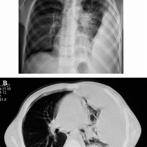 A Chest X Ray Shows A Large Pleural Effusion In Left Hemithorax B