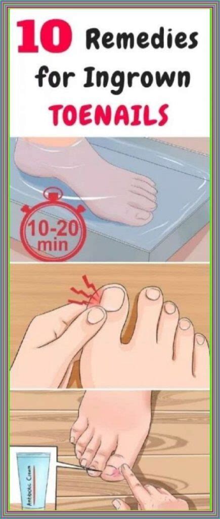 10 Remedies for Ingrown Toenails – Healthy