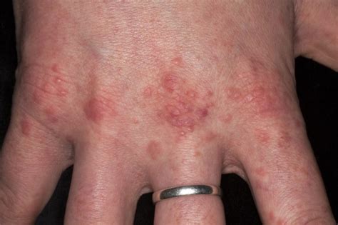 Hepatitis Symptoms Skin