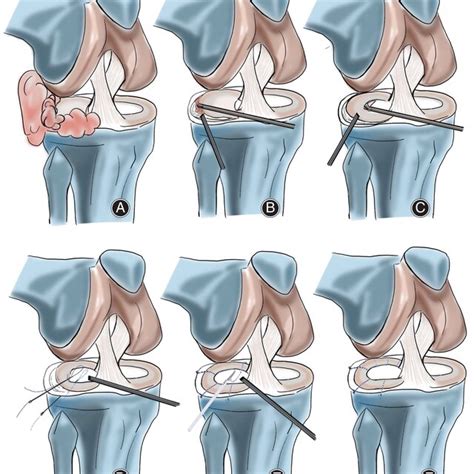 Schematic Diagram Of The Arthroscopic Procedure For A Giant Meniscal