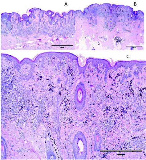 Combined Nevus Histopathological Findings A Epidermal And Dermal