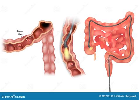 POLYPS OF THE COLON Intestines Medicine Anatomy Vector Scheme Royalty