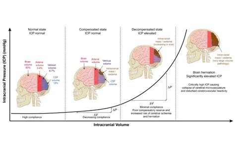 Understanding Intracranial Pressure Icp Exploring The Monro Kellie