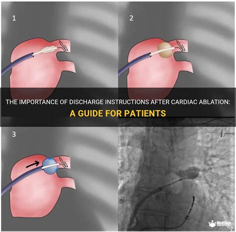 The Importance Of Discharge Instructions After Cardiac Ablation A Guide For Patients Medshun