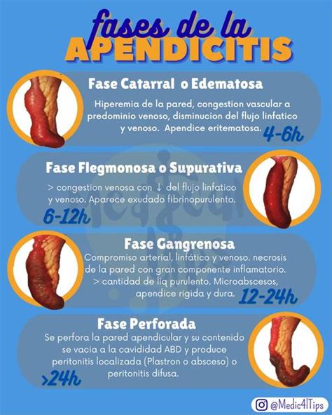 Res Menes De Etapas De La Apendicitis Descarga Apuntes De Etapas De