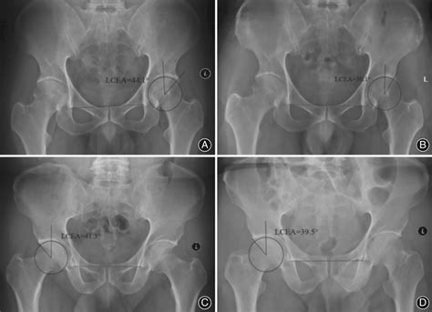 Preoperative And Postoperative Ap Radiographs Of The Pelvis In The High