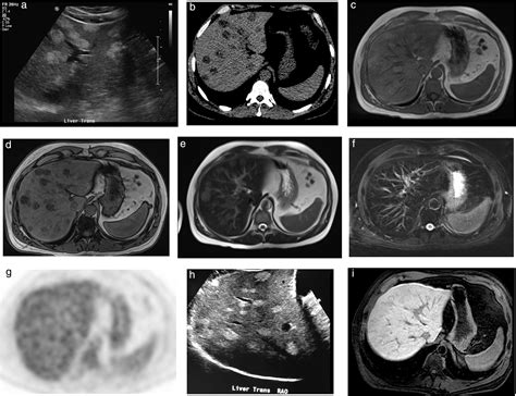 Multifocal Hepatic Steatosis Mimicking Malignancy In Two Siblings